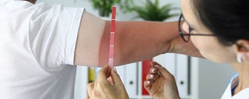 Como Fornecer Assistência de Enfermagem Dermatológica ao Paciente Queimado